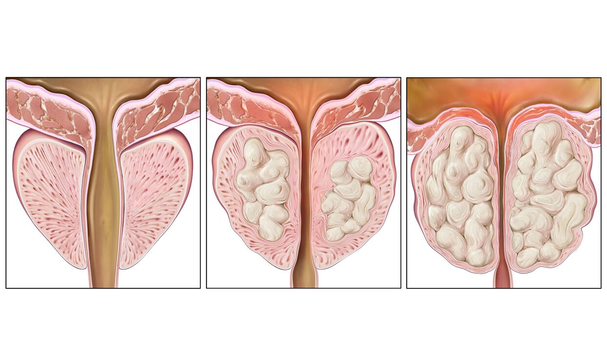 prostate cancer stages