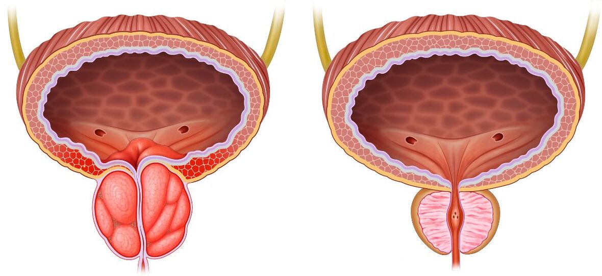 healthy and diseased prostate